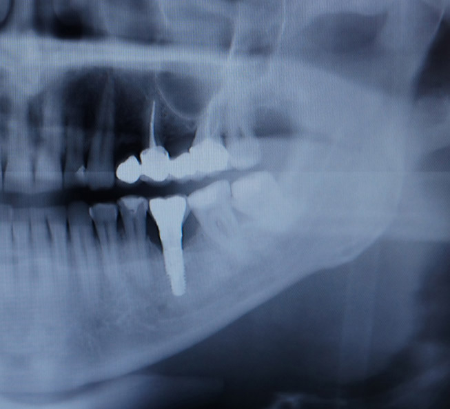 Röntgenaufnahme mit Zahnimplantaten und Implantationsschablone